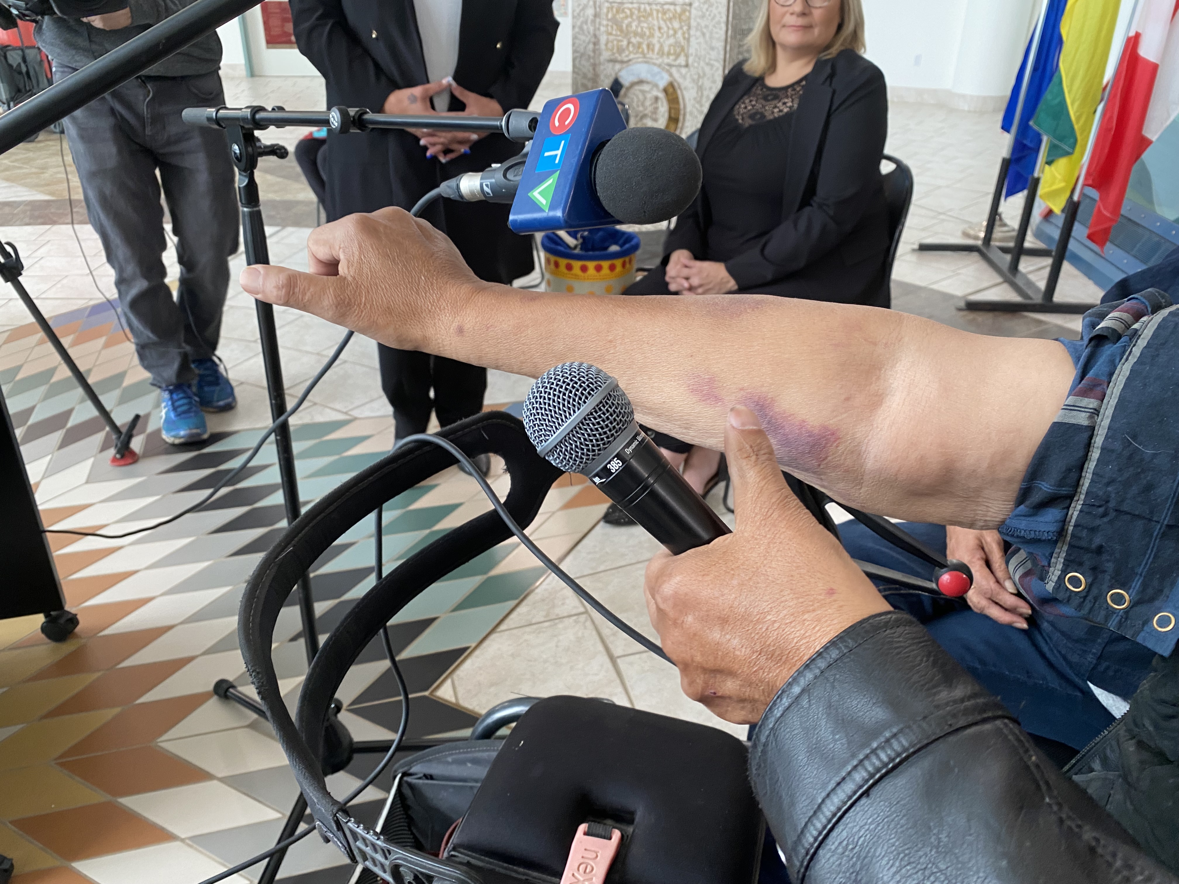 Another bruise on Favel’s arm as he told his story at the press conference at First Nations University