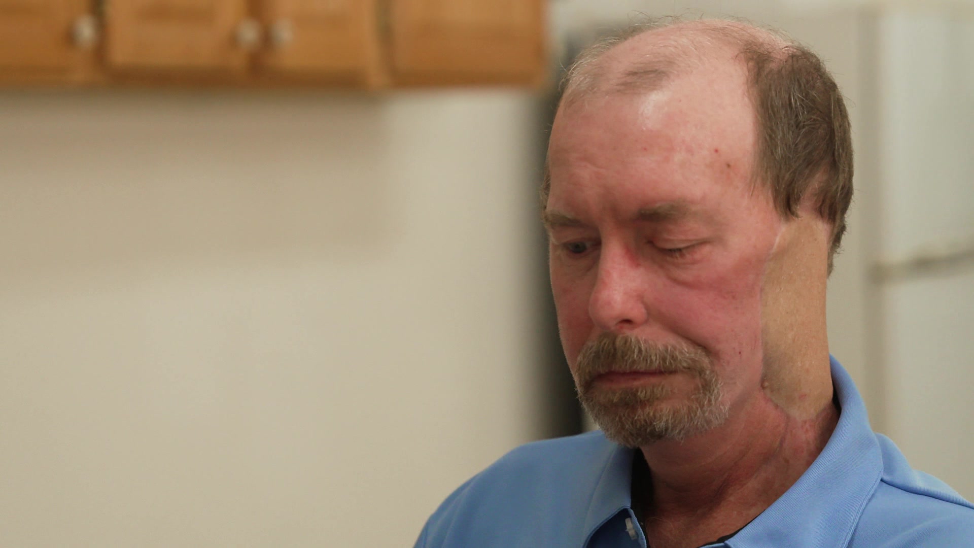 Cancer survivor Steve Butler, before getting his prosthetic ear.