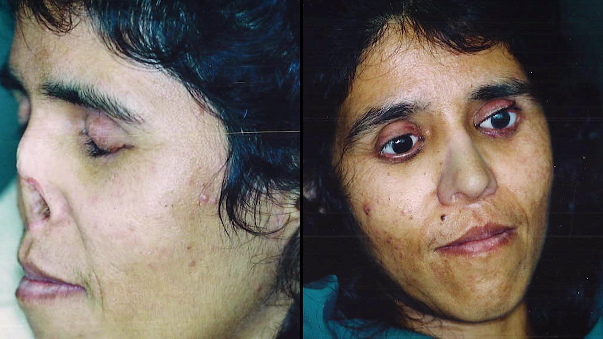 Before and after of Zahida Parveen, who was disfigured by her husband.