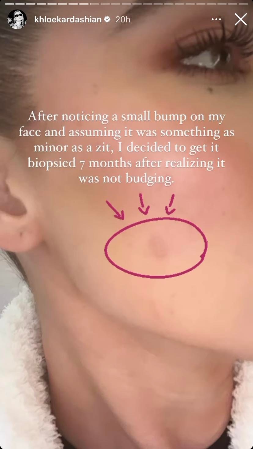 A close-up of Khloe Kardashian's face with the tumour she believed to be a zit.