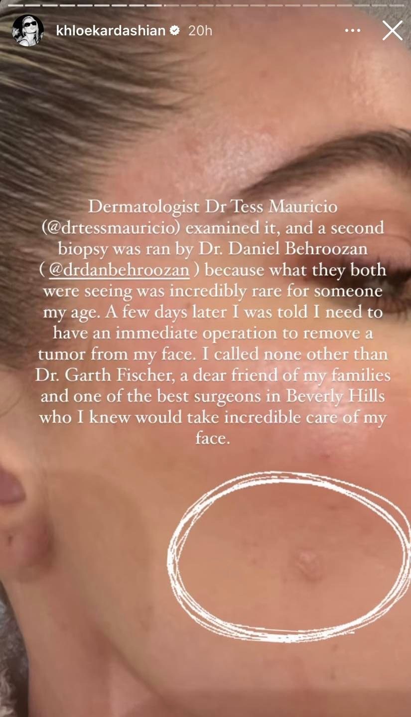 A close-up of the tumour on Khloe Kardashian's face.