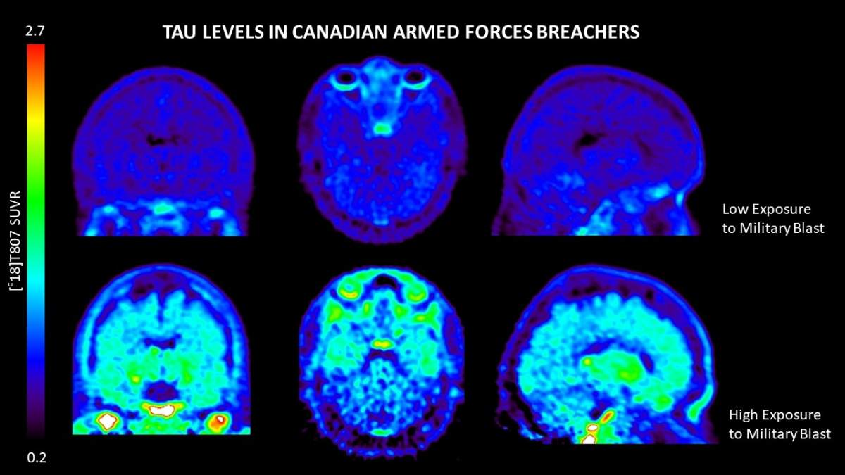 PET Scan of Canadian Armed Forces Soldiers