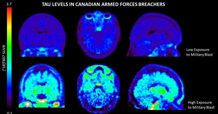 Veterans and mental ailment — How Canadian research could unlock the mysteries of the brain – Countrywide