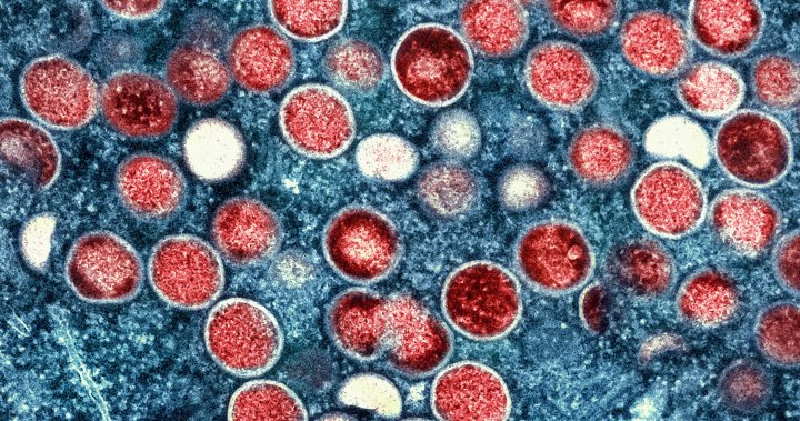 Monkeypox infections ‘steadily decreasing’ in Canada, PHAC declares