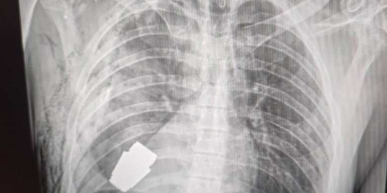 Unexploded grenade extracted from Ukrainian soldier's chest in remarkable surgery
