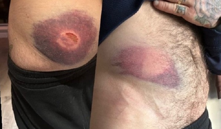 Elijah Barnett shows off injuries he sustained from a police rubber bullet gun during a mistaken arrest.