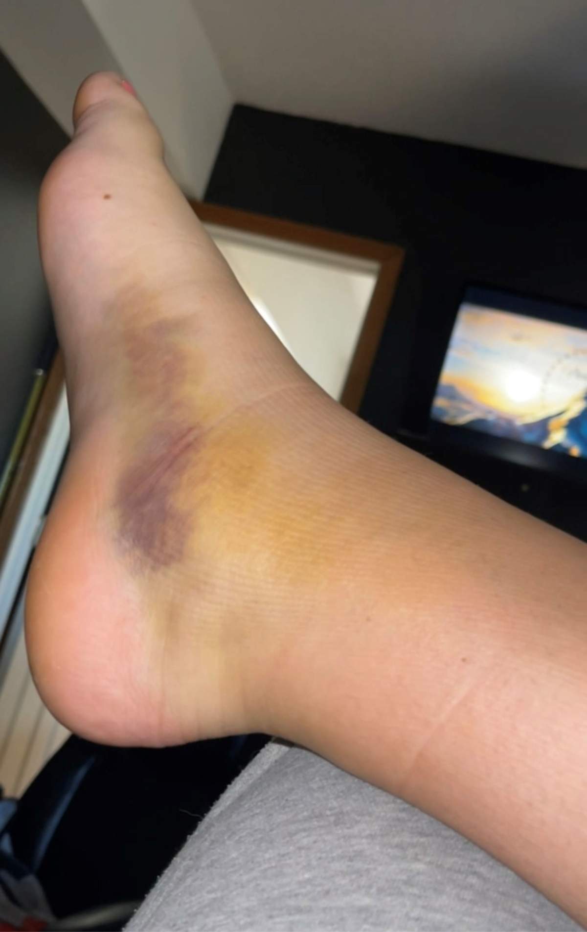 Patient Sydney Wideman’s broken foot.