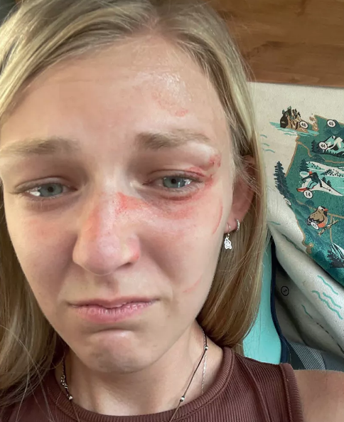 Gabby Petito with facial injuries. There are tears in her eyes.