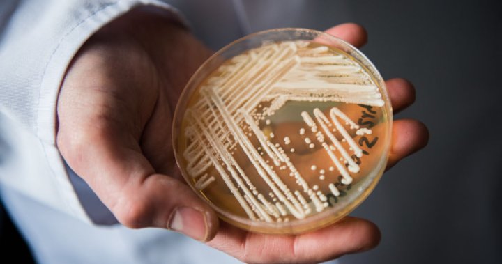 ‘Worsening spread’ of deadly fungal infection raising alarm in U.S.