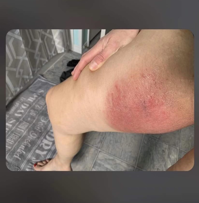 Blister on inner thigh (pic included)
