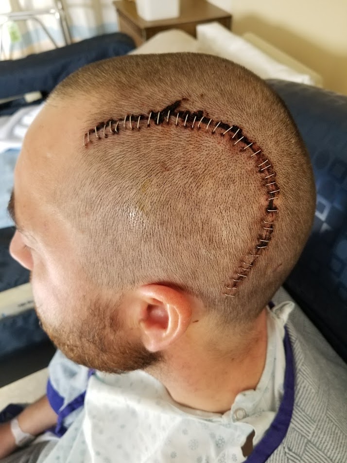 The aftermath of Brennon Dulle’s brain surgery.