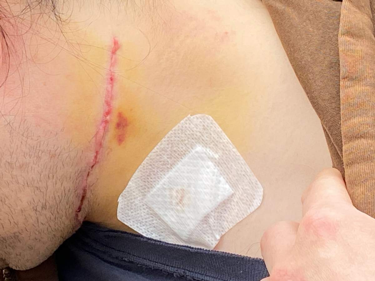 Surrey bus attack victim shows gash on his neck where he was slashed by man accused of supporting ISIS.