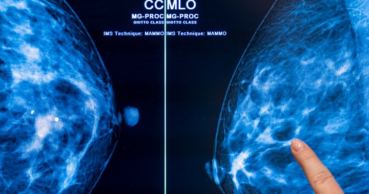 The U.S. may lower the breast cancer screening age to 40. Should Canada follow?