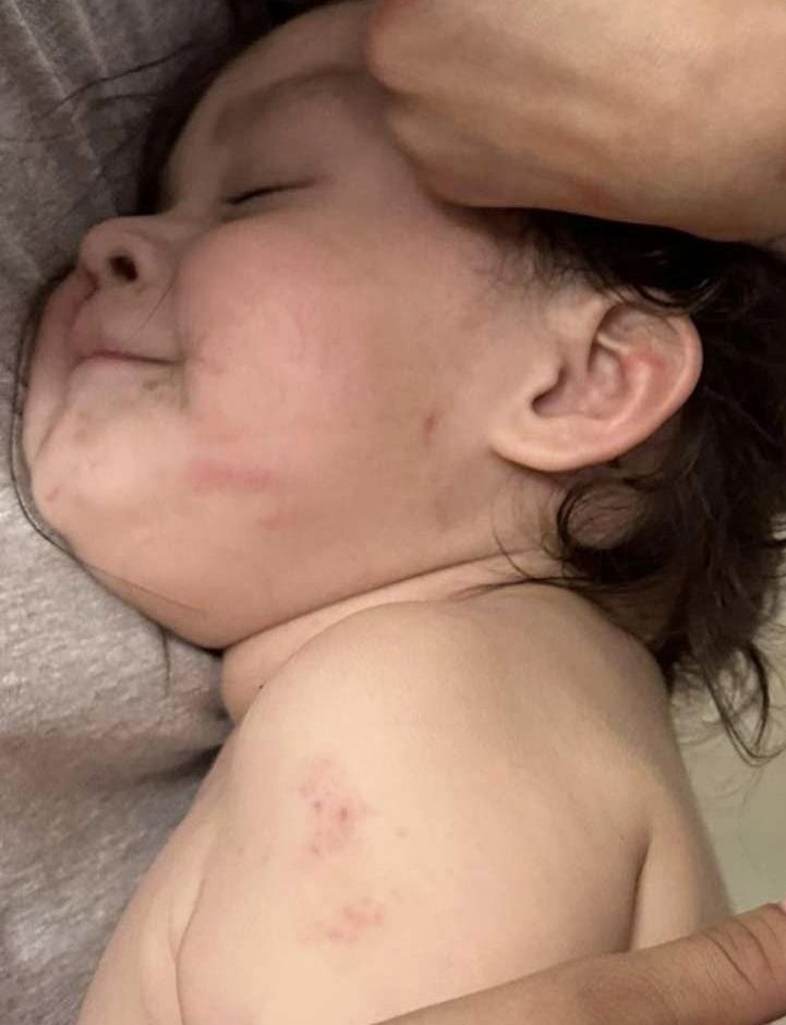 Regina mom fights for answers after son comes home from daycare with unexplained marks - image