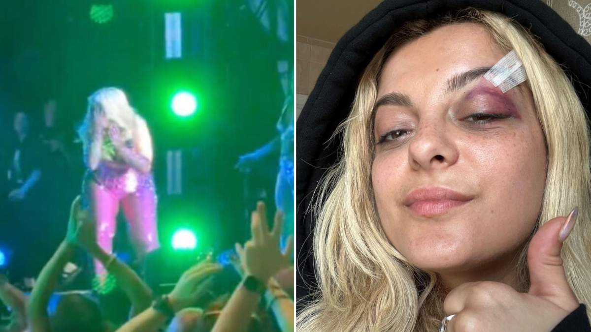 A split photo. On the left, Bebe Rexha is on stage holding her face just after she was hit with the phone. On the right, is a selfie from Bebe Rexha. She has a black eye and bandages on her eyebrow.