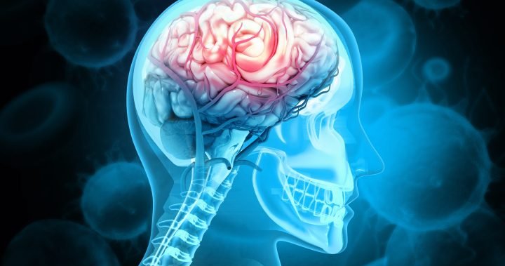 Brain inflammation found in long COVID patients: Canadian study