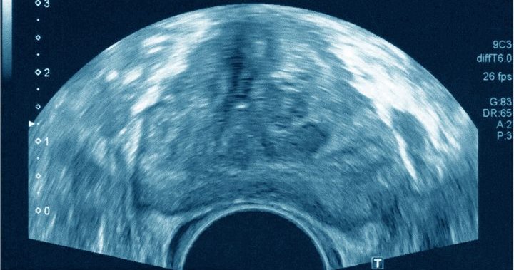 Higher risk of aggressive prostate cancer in Indigenous men, study shows  | Globalnews.ca