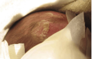 Sexually transmitted infections on the rise in Alberta; massive spike in babies born with syphillis - Vimarsana News
