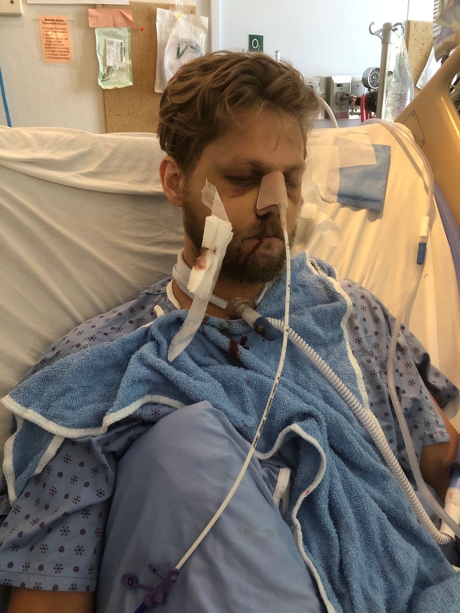 “I thought he was dying”; Kelowna woman recalls harrowing ordeal of tree falling on her and her son – Okanagan | 24CA News