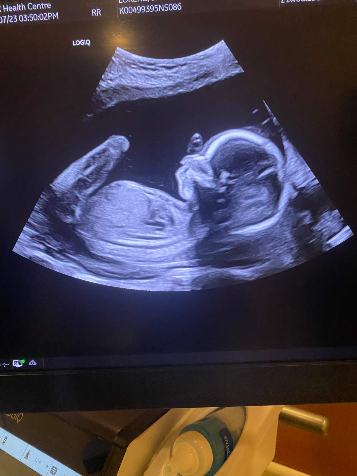 A sonogram of Desmond and Lorenz's expected child.