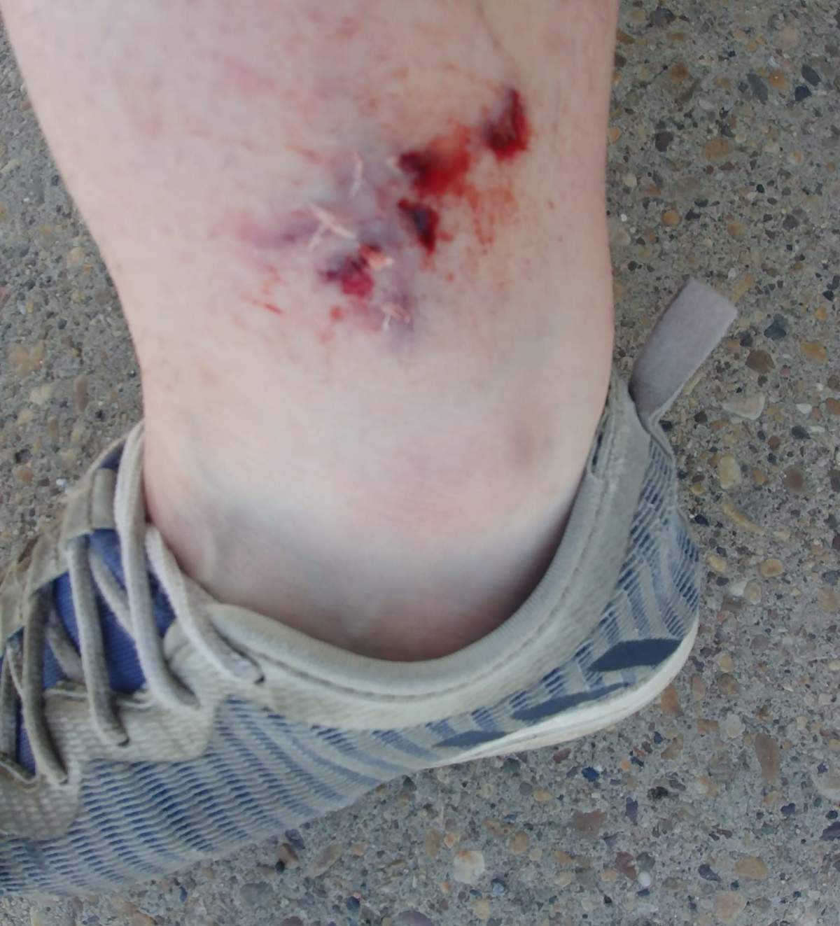 Kelsey Anderson was attacked by a dog in northeast Edmonton's Abbottsfield area on Aug. 12, 2023.