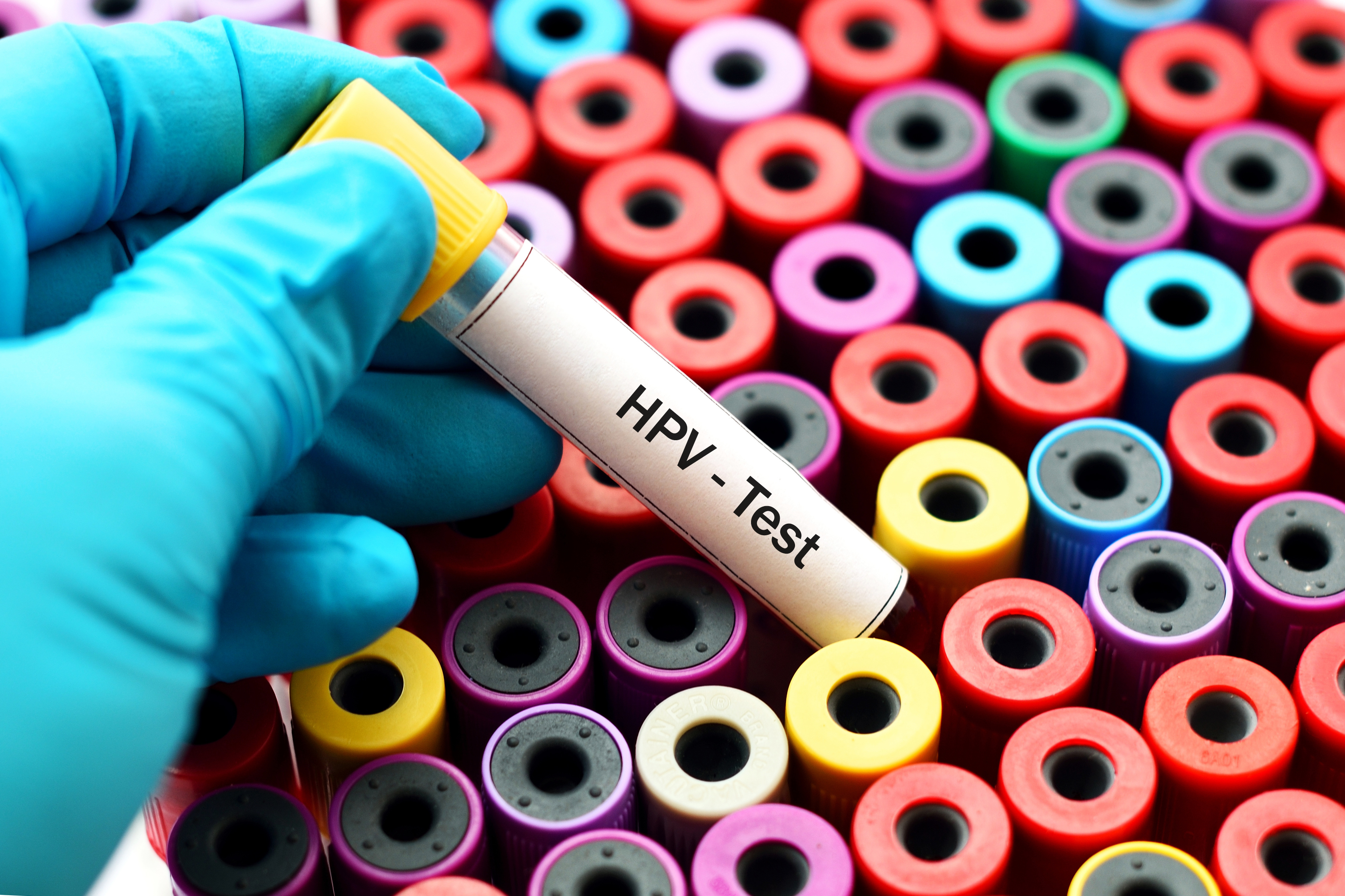 Health Canada urged to approve HPV self-testing for cervical cancer 