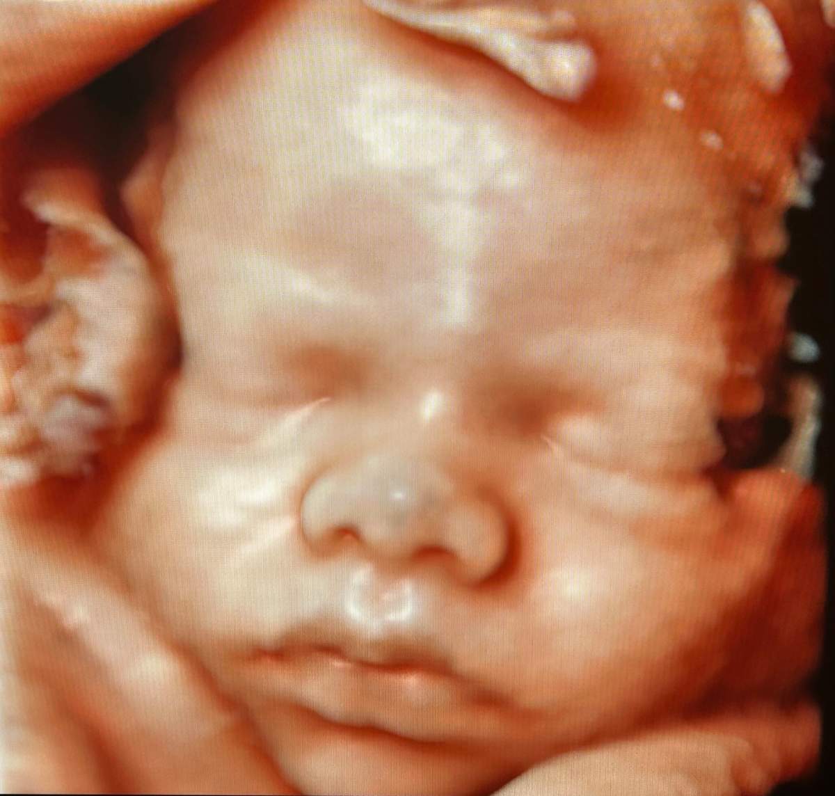 4D maternal ultrasound pictures from The Voluson™ Expert 22 ultrasound machine.