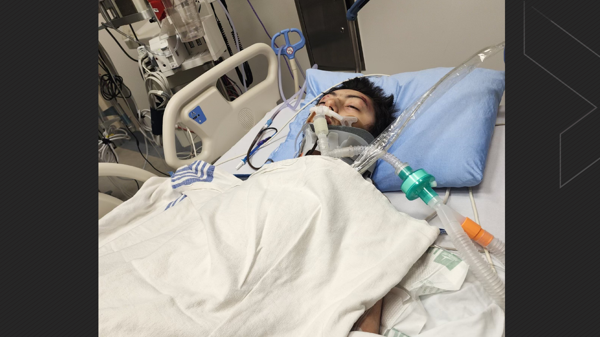 Calgary teen faces long road to recovery after being struck by 2 vehicles