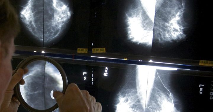 Правителството на Саскачеван ще изпраща пациенти за скрининг на рак на гърдата в частна компания в Калгари