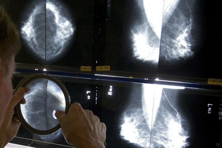 Saskatchewan government to send breast cancer screening patients to private company in Calgary