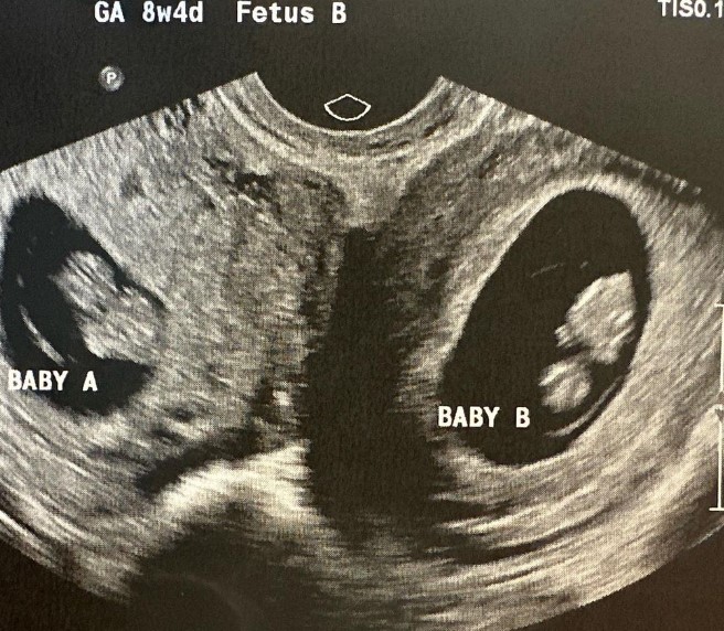 Kelsey Hatcher, 32, has long known that she was born with two uteri and two cervixes, but did not expect the double pregnancy.