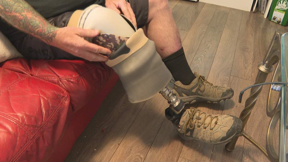 Chris Miners had a foot amputated last year after contracting flesh eating disease.