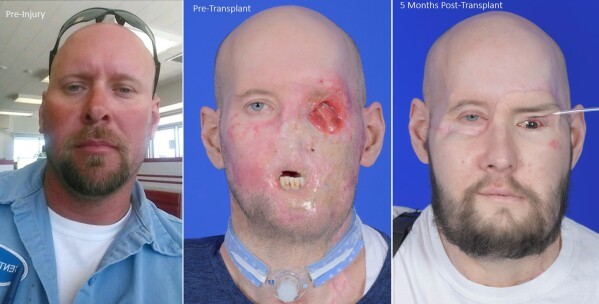 A three-paneled photo. On the left is Aaron James before his accident. In the centre is James after his accident. He is missing his eye, lips, several teeth and part of his chin. On the right is James after his surgery. An apparatus is holding open the lid of John's new eye.