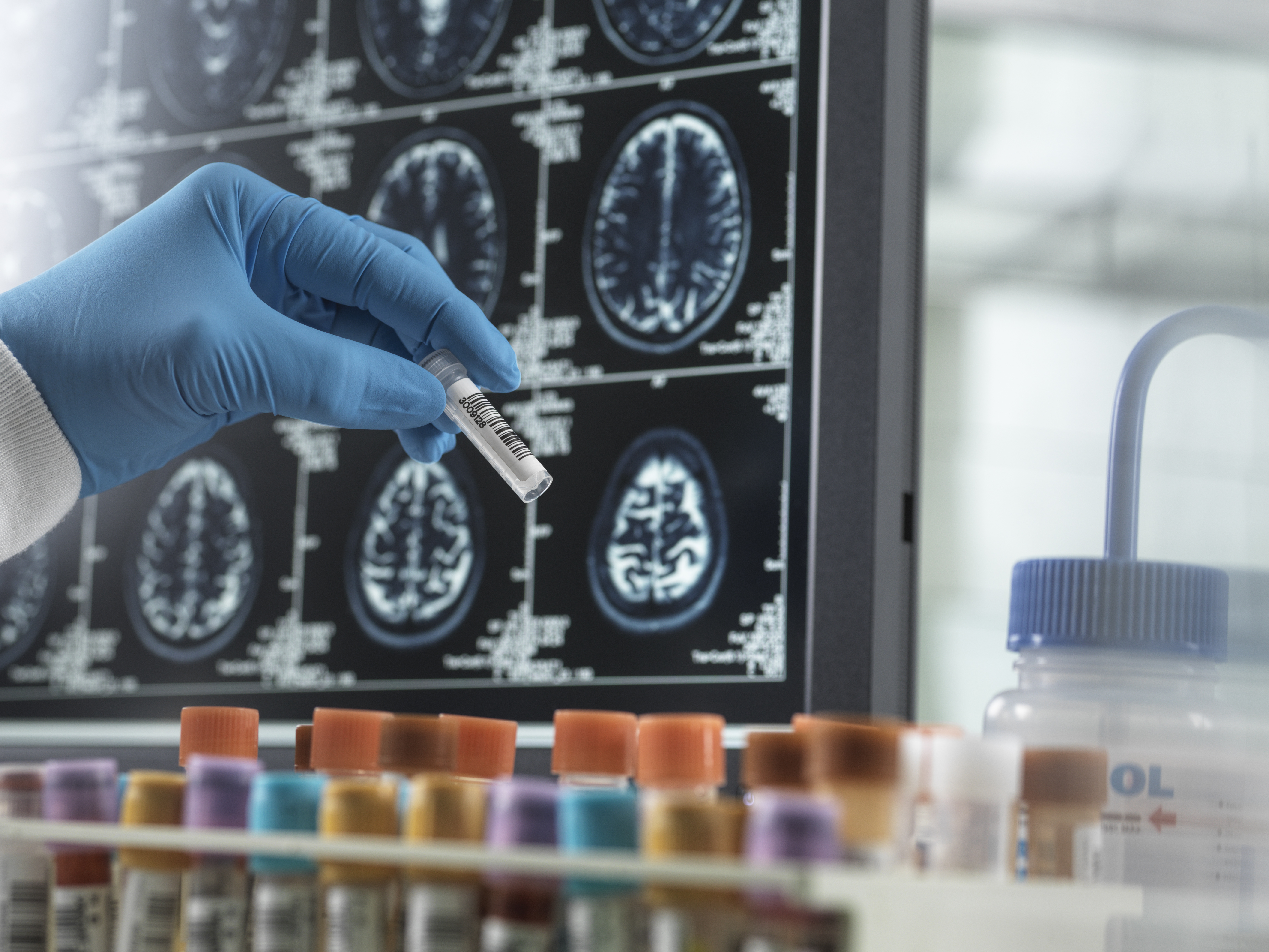 Conceptual image of clinical research to develop a possible cure for Alzheimer's and dementia