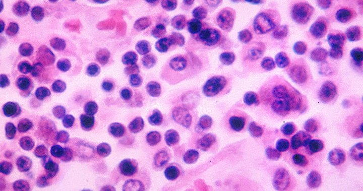 公共卫生部门称，新斯科舍省4例沙门氏菌感染病例与致命的全国性爆发有关