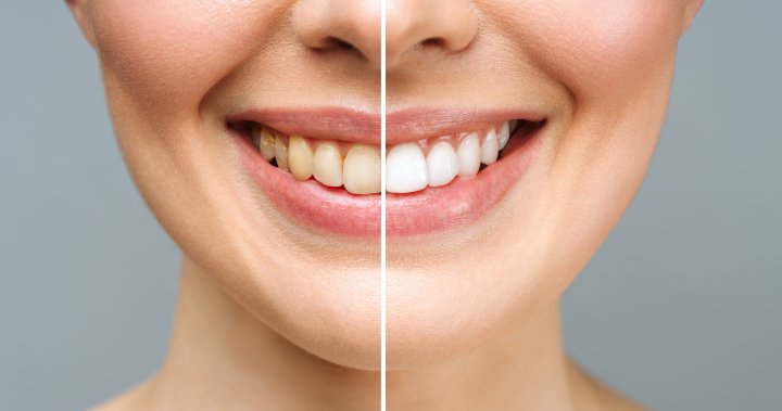 Освежете усмивката си: 5 продукта за избелване на зъби за чувствителни зъби