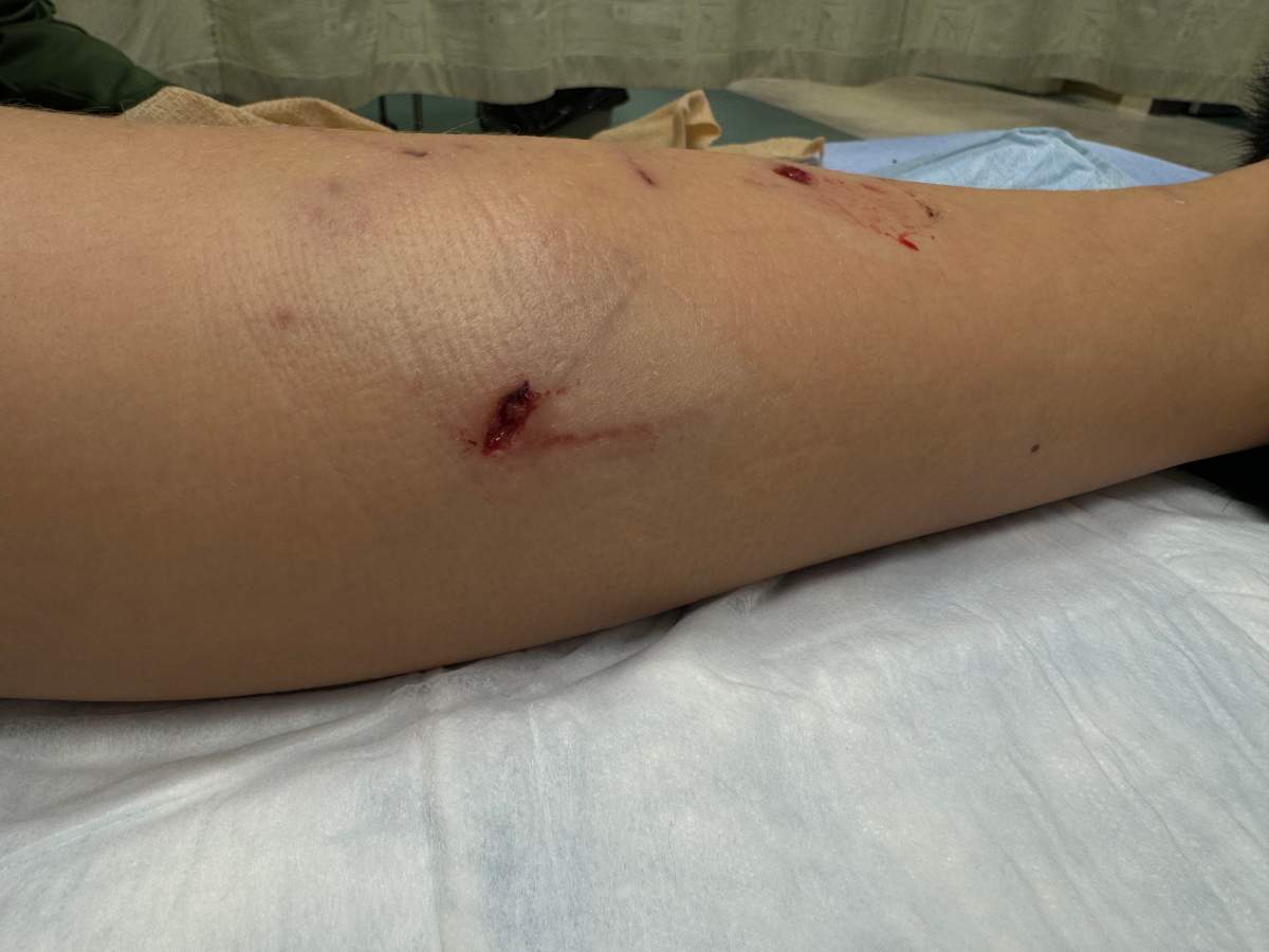 Puncture wounds on the leg of an 11-year-old girl after she was attacked by a coyote on Boxing Day at a Trans-Canada Highway rest stop in southern Alberta.