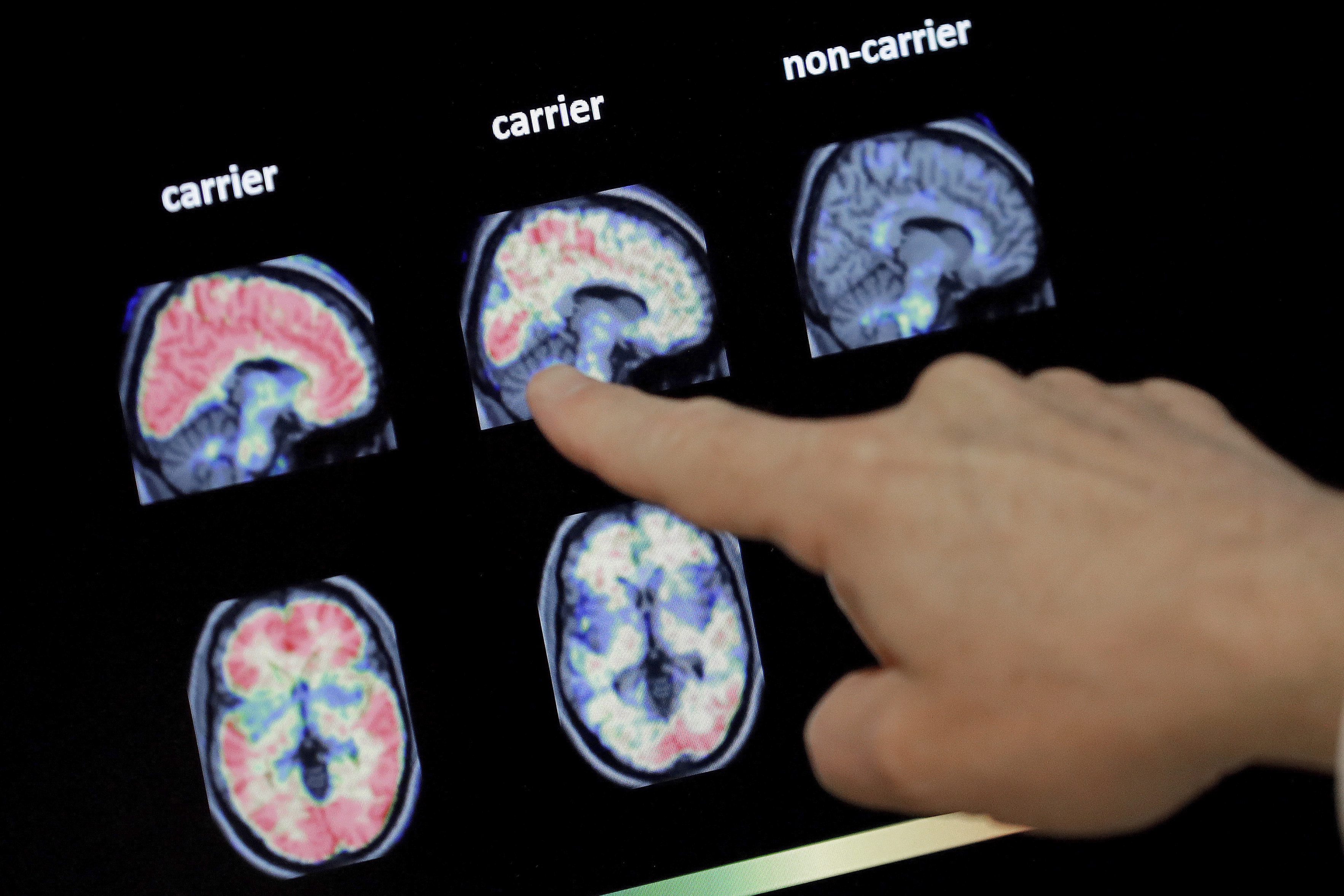 Drug to treat agitation in Alzheimer’s patients approved in Canada