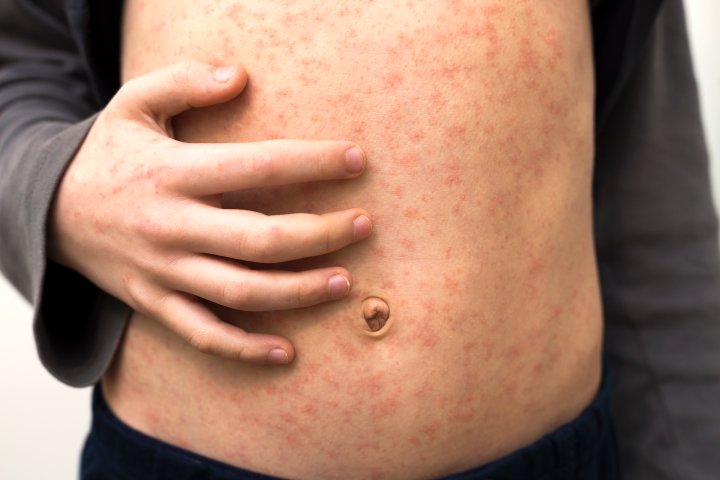 Measles exposure possible at Toronto mom and babies programs: TPH