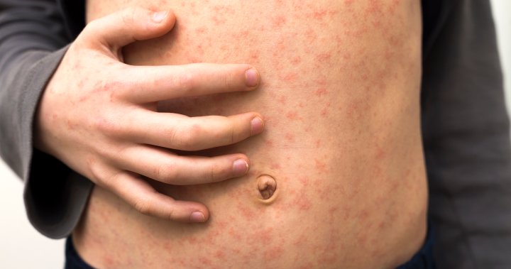 More measles cases reported in Ontario in 2024 than all cases in the previous year