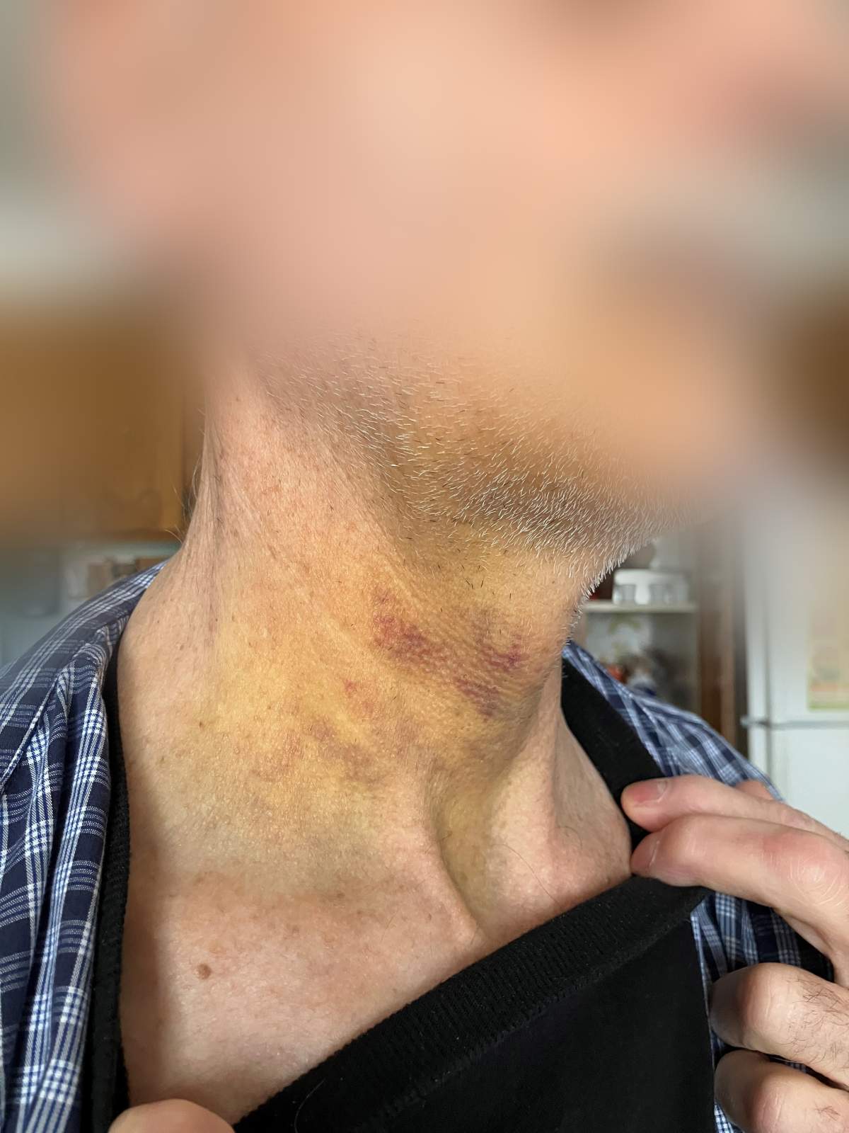 Roman was working as a substitute teacher in Saskatchewan when he was attacked by a student, resulting in his jaw being broken in multiple places.