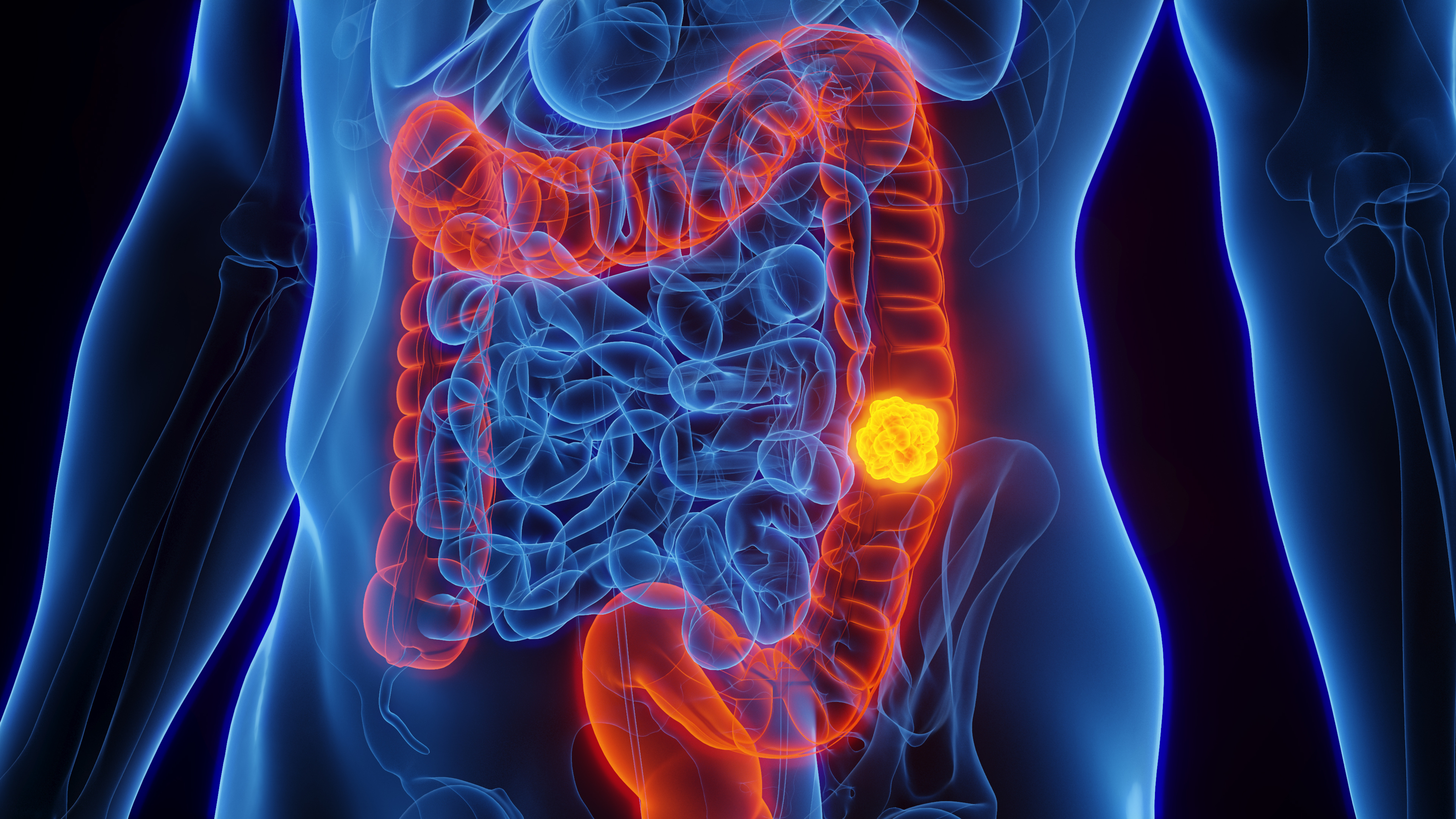 Drug for cocaine addiction could help treat colorectal cancer, research shows