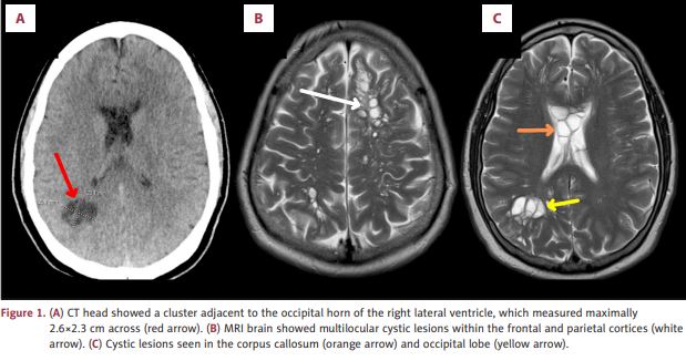 Neurocysticercosis is a condition caused by Taenia solium when cysts embed within the nervous system [