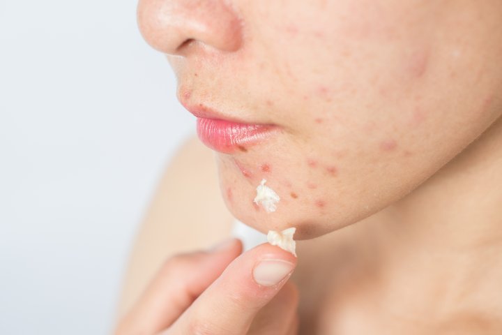 Health Canada ‘reviewing’ U.S. lab’s findings of benzene in acne products