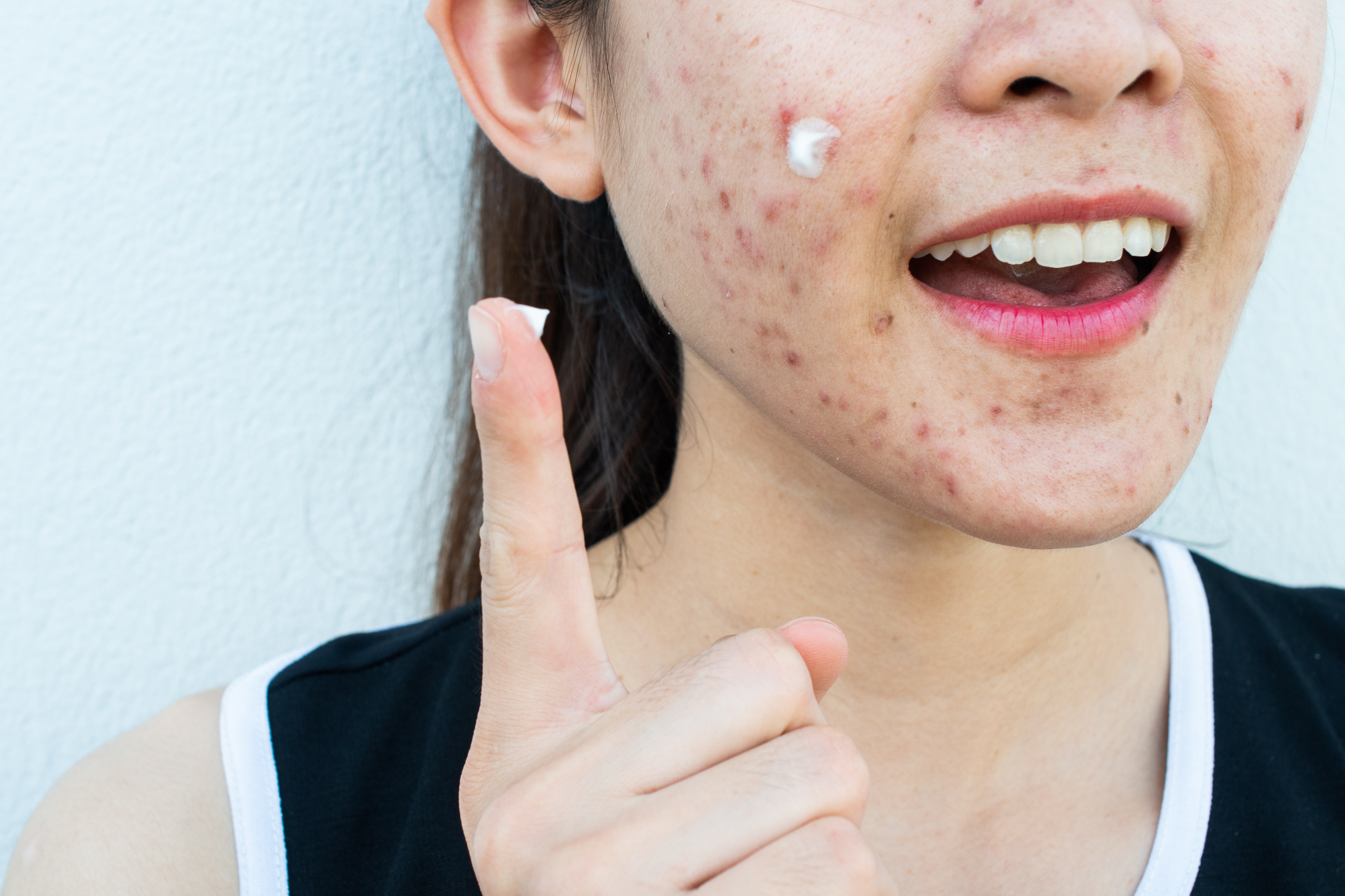 Cancer Causing Chemical Benzene Found In Popular Acne Products U S   GettyImages 1474737314 