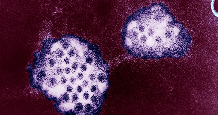 Случаите на норовирус силно заразна стомашна болест нарастват в Съединените