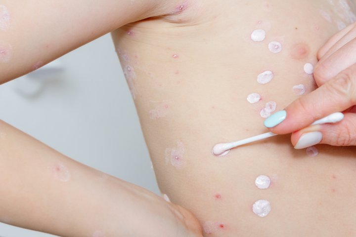 More Canadians see measles as dangerous compared to COVID, flu: poll
