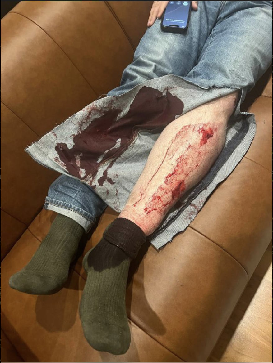 The bloodied legs of Leonid Volkov after he was attacked in Lithuania.