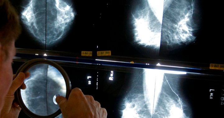 Започнете скрининга за рак на гърдата на 40-годишна възраст, призовава Канадското онкологично дружество