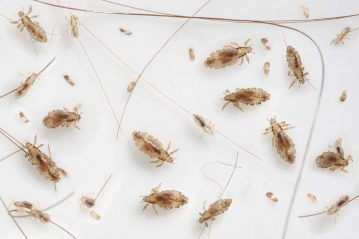 Drug-resistant ‘super lice’ creating challenges for families, experts say